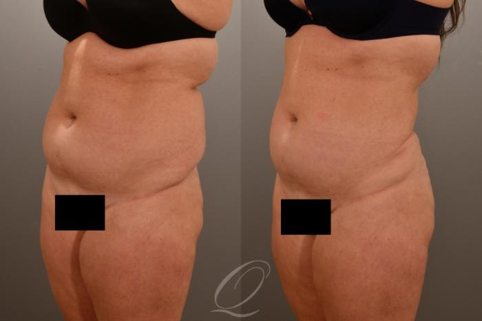 Liposuction Case 1001669 Before & After Left Oblique | Serving Rochester, Syracuse & Buffalo, NY | Quatela Center for Plastic Surgery