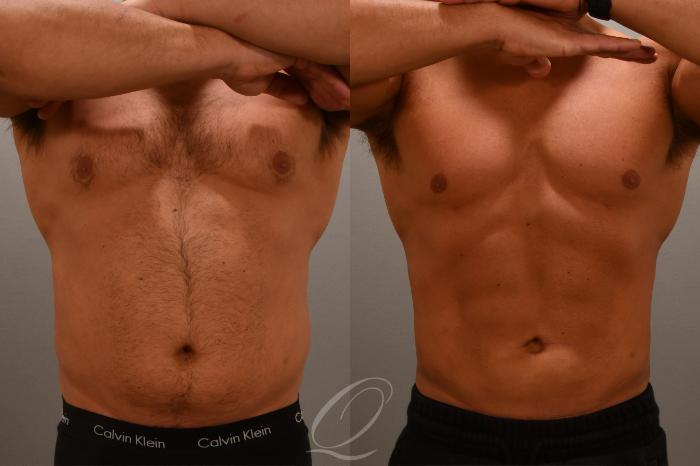 Liposuction Case 1001670 Before & After Front | Serving Rochester, Syracuse & Buffalo, NY | Quatela Center for Plastic Surgery