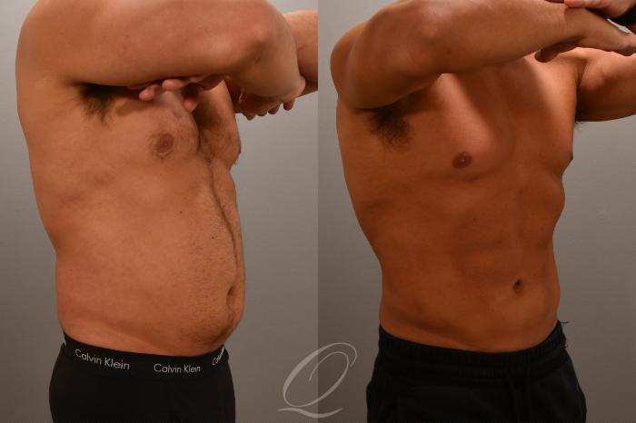 Liposuction Case 1001670 Before & After Right Oblique | Serving Rochester, Syracuse & Buffalo, NY | Quatela Center for Plastic Surgery