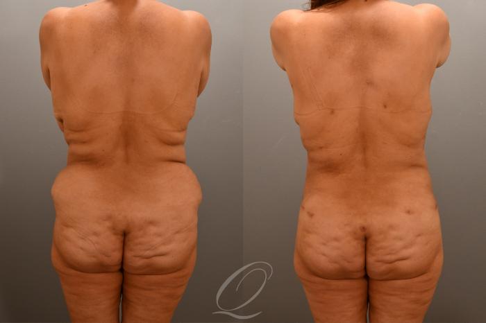 Liposuction Case 1001671 Before & After Back | Serving Rochester, Syracuse & Buffalo, NY | Quatela Center for Plastic Surgery