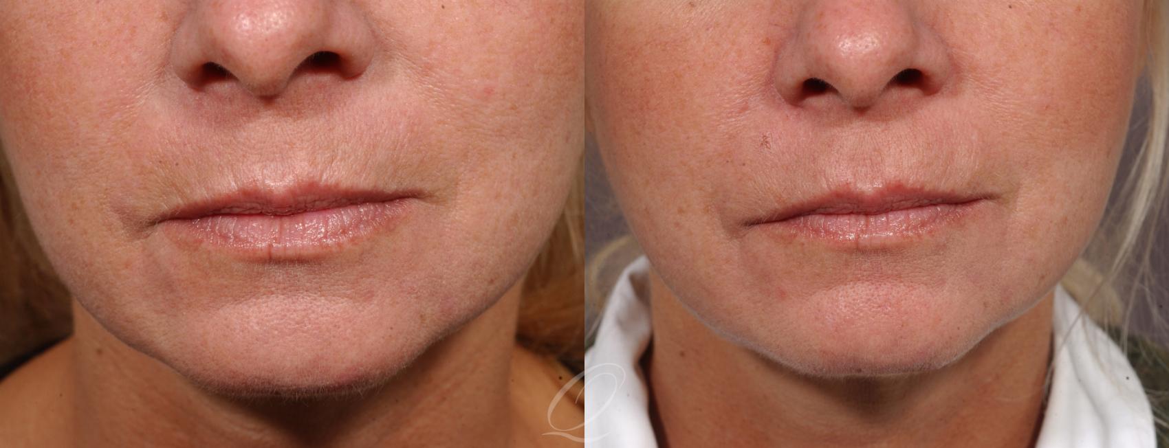 Restylane® Case 215 Before & After View #1 | Serving Rochester, Syracuse & Buffalo, NY | Quatela Center for Plastic Surgery