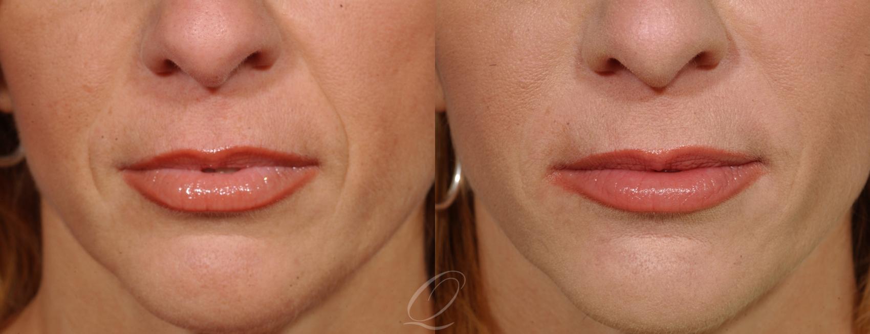 Restylane® Case 217 Before & After View #1 | Serving Rochester, Syracuse & Buffalo, NY | Quatela Center for Plastic Surgery