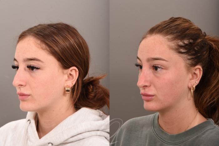 Revision Rhinoplasty Case 1001745 Before & After Left Oblique | Serving Rochester, Syracuse & Buffalo, NY | Quatela Center for Plastic Surgery