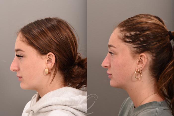Revision Rhinoplasty Case 1001745 Before & After Left Side | Serving Rochester, Syracuse & Buffalo, NY | Quatela Center for Plastic Surgery