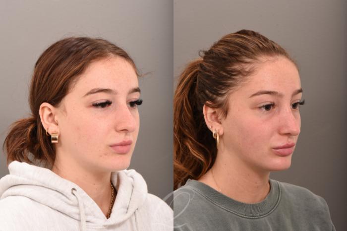 Revision Rhinoplasty Case 1001745 Before & After Right Oblique | Serving Rochester, Syracuse & Buffalo, NY | Quatela Center for Plastic Surgery