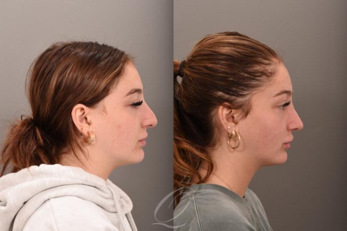 Revision Rhinoplasty Case 1001745 Before & After Right Side | Serving Rochester, Syracuse & Buffalo, NY | Quatela Center for Plastic Surgery
