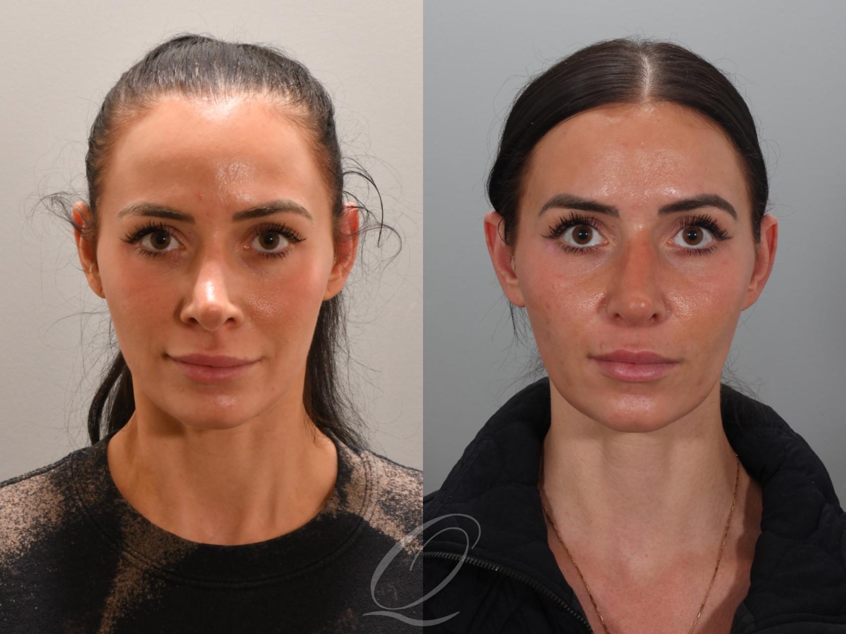 Revision Rhinoplasty Case 1001946 Before & After Front | Serving Rochester, Syracuse & Buffalo, NY | Quatela Center for Plastic Surgery