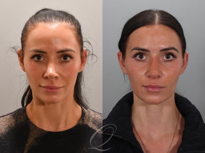 Revision Rhinoplasty Case 1001946 Before & After Front | Serving Rochester, Syracuse & Buffalo, NY | Quatela Center for Plastic Surgery