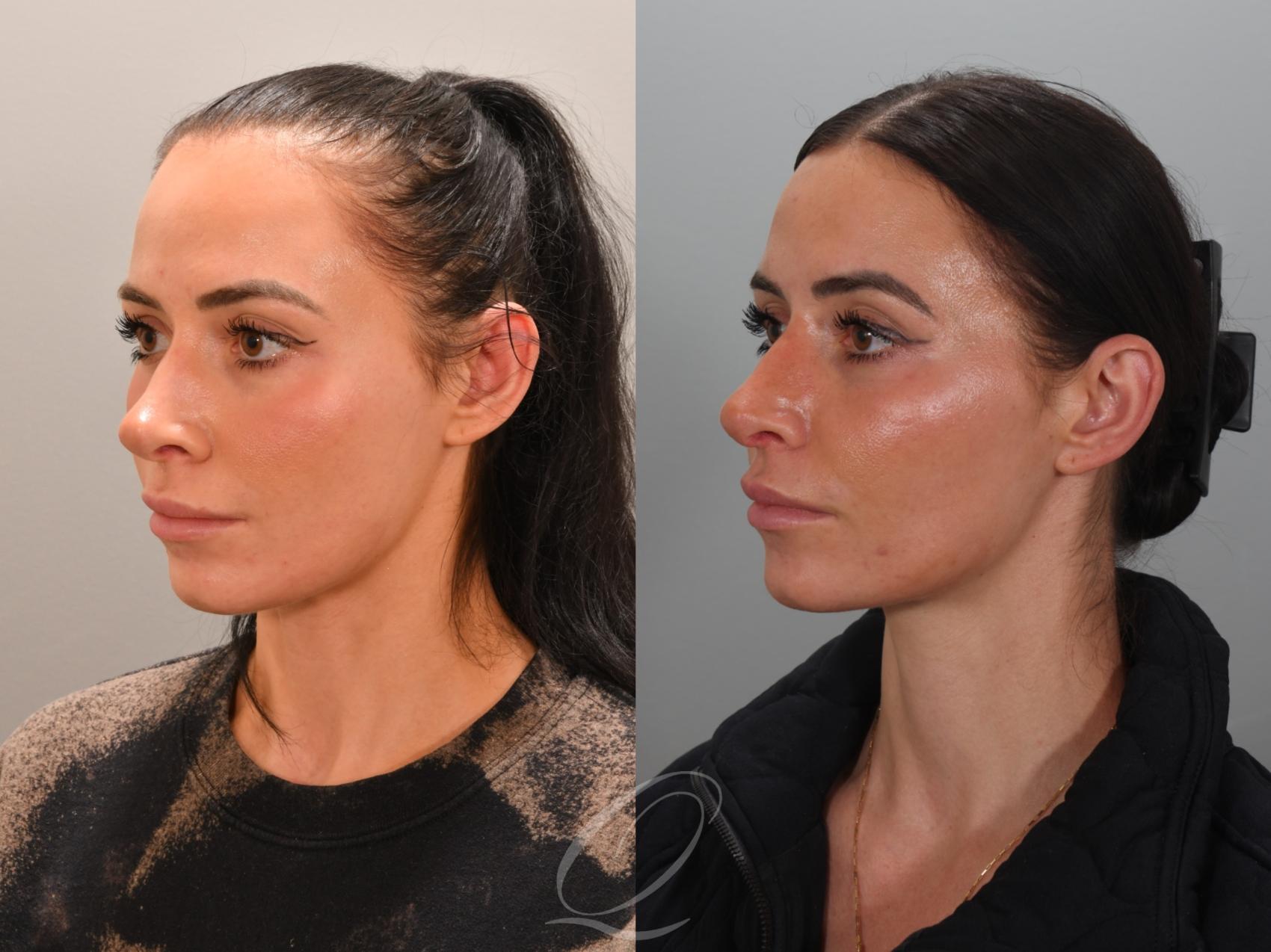 Revision Rhinoplasty Case 1001946 Before & After Left Oblique | Serving Rochester, Syracuse & Buffalo, NY | Quatela Center for Plastic Surgery