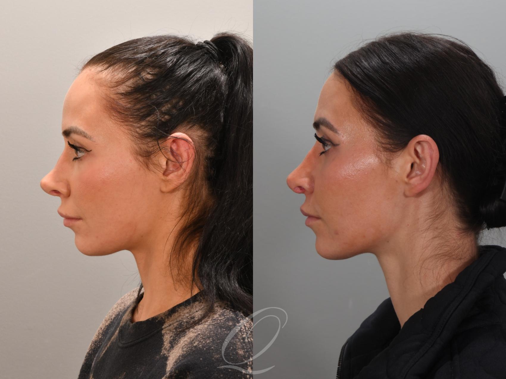 Revision Rhinoplasty Case 1001946 Before & After Left Side | Serving Rochester, Syracuse & Buffalo, NY | Quatela Center for Plastic Surgery