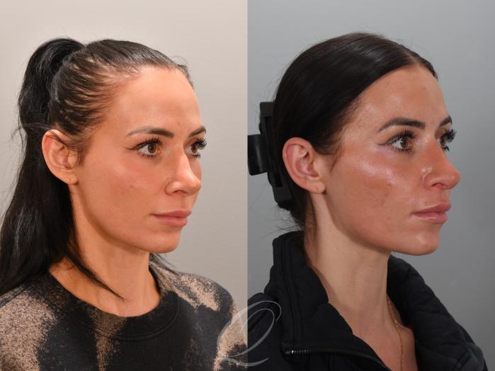 Revision Rhinoplasty Case 1001946 Before & After Right Oblique | Serving Rochester, Syracuse & Buffalo, NY | Quatela Center for Plastic Surgery