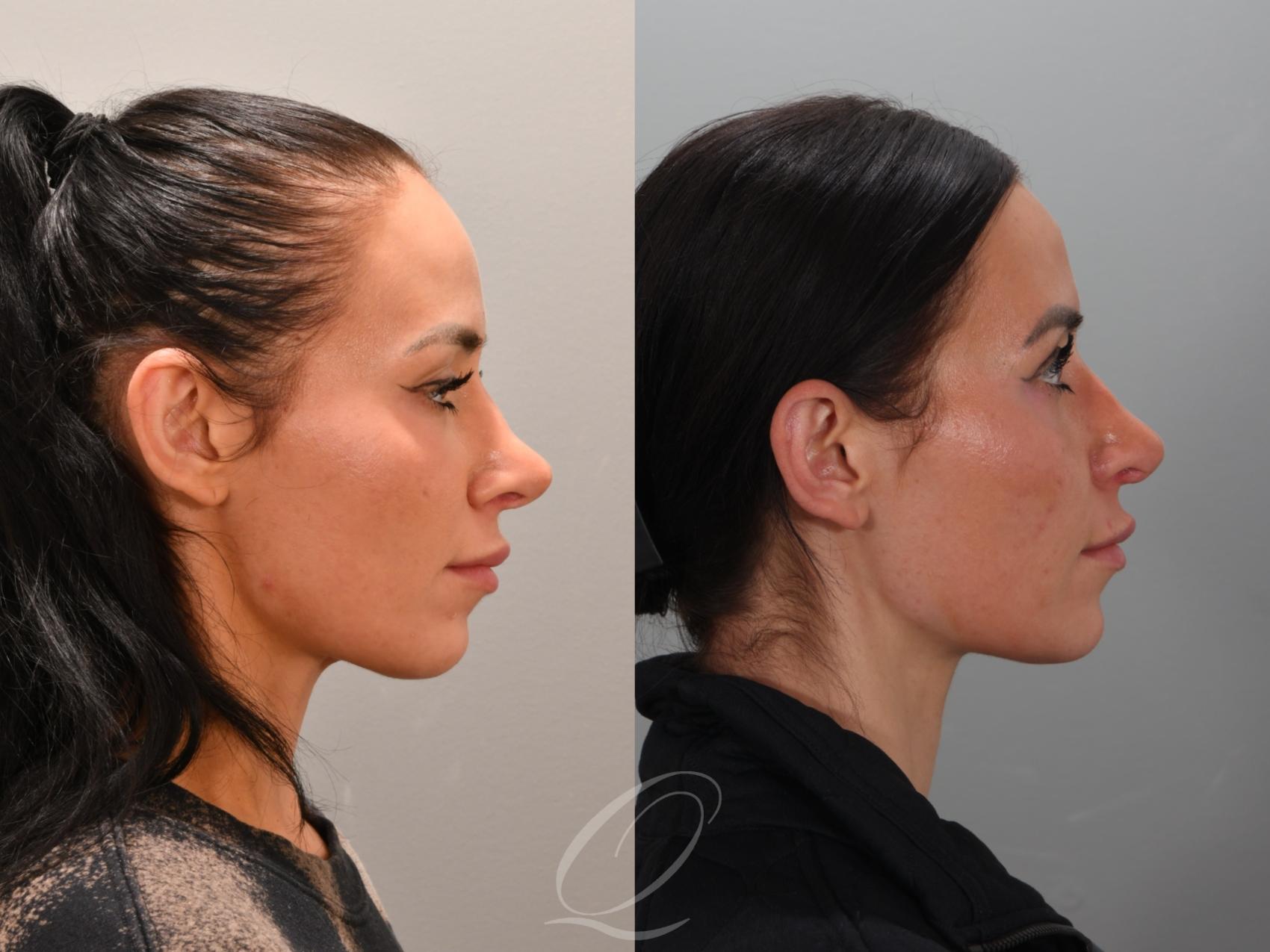 Revision Rhinoplasty Case 1001946 Before & After Right Side | Serving Rochester, Syracuse & Buffalo, NY | Quatela Center for Plastic Surgery