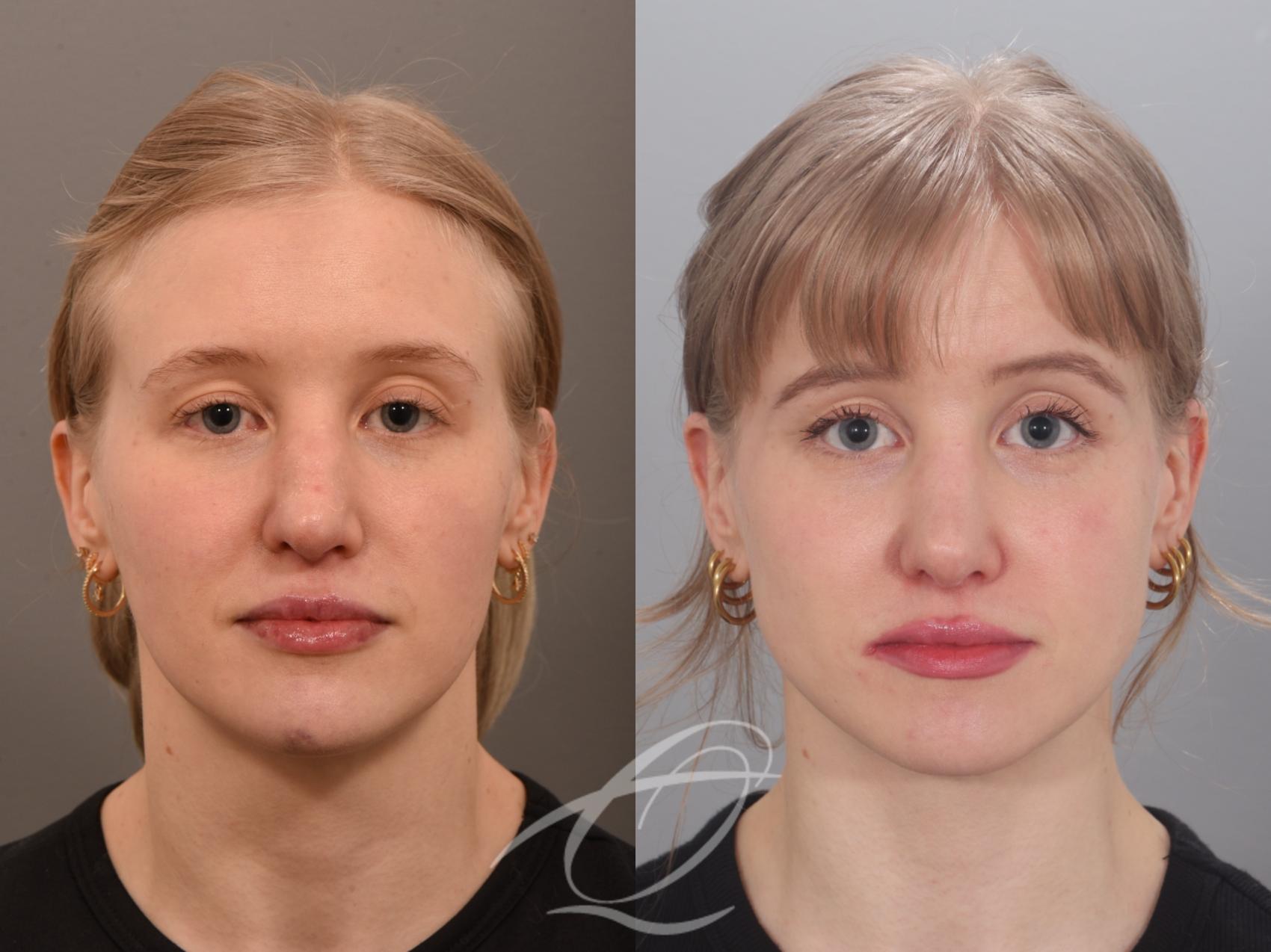 Revision Rhinoplasty Case 1002012 Before & After Front | Serving Rochester, Syracuse & Buffalo, NY | Quatela Center for Plastic Surgery