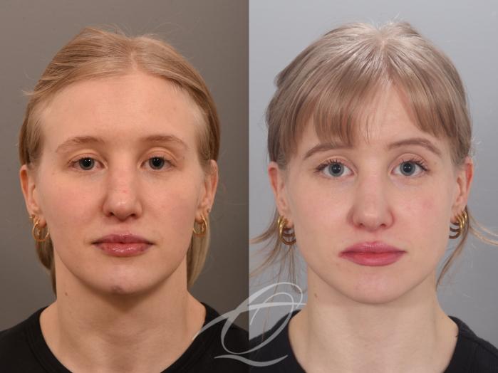 Revision Rhinoplasty Case 1002012 Before & After Front | Serving Rochester, Syracuse & Buffalo, NY | Quatela Center for Plastic Surgery