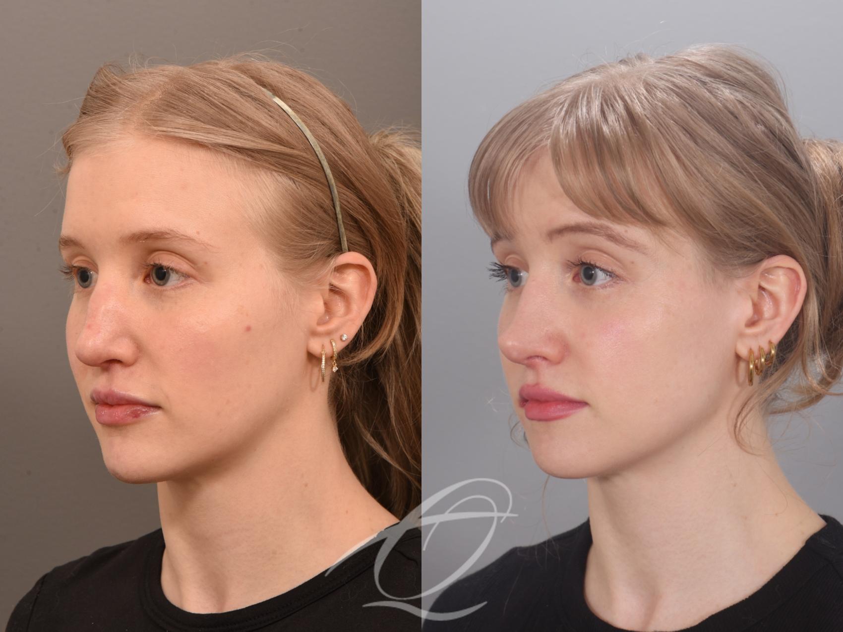 Revision Rhinoplasty Case 1002012 Before & After Left Oblique | Serving Rochester, Syracuse & Buffalo, NY | Quatela Center for Plastic Surgery