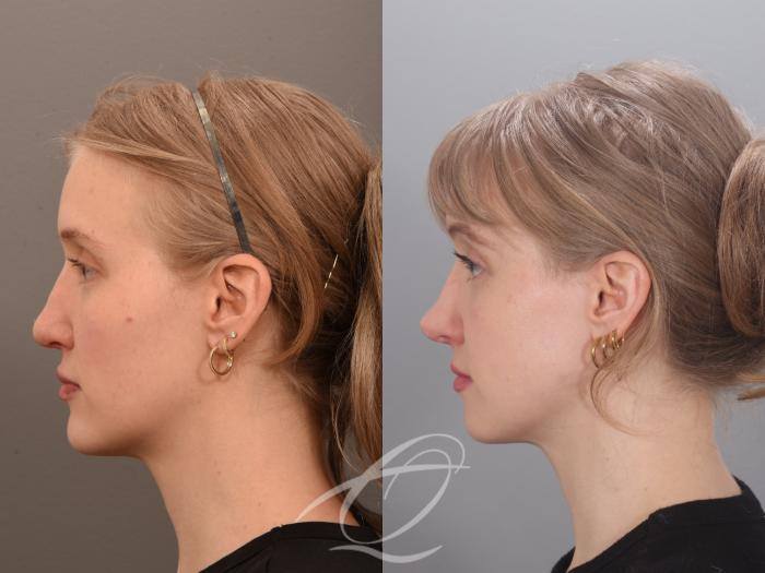 Revision Rhinoplasty Case 1002012 Before & After Left Side | Serving Rochester, Syracuse & Buffalo, NY | Quatela Center for Plastic Surgery