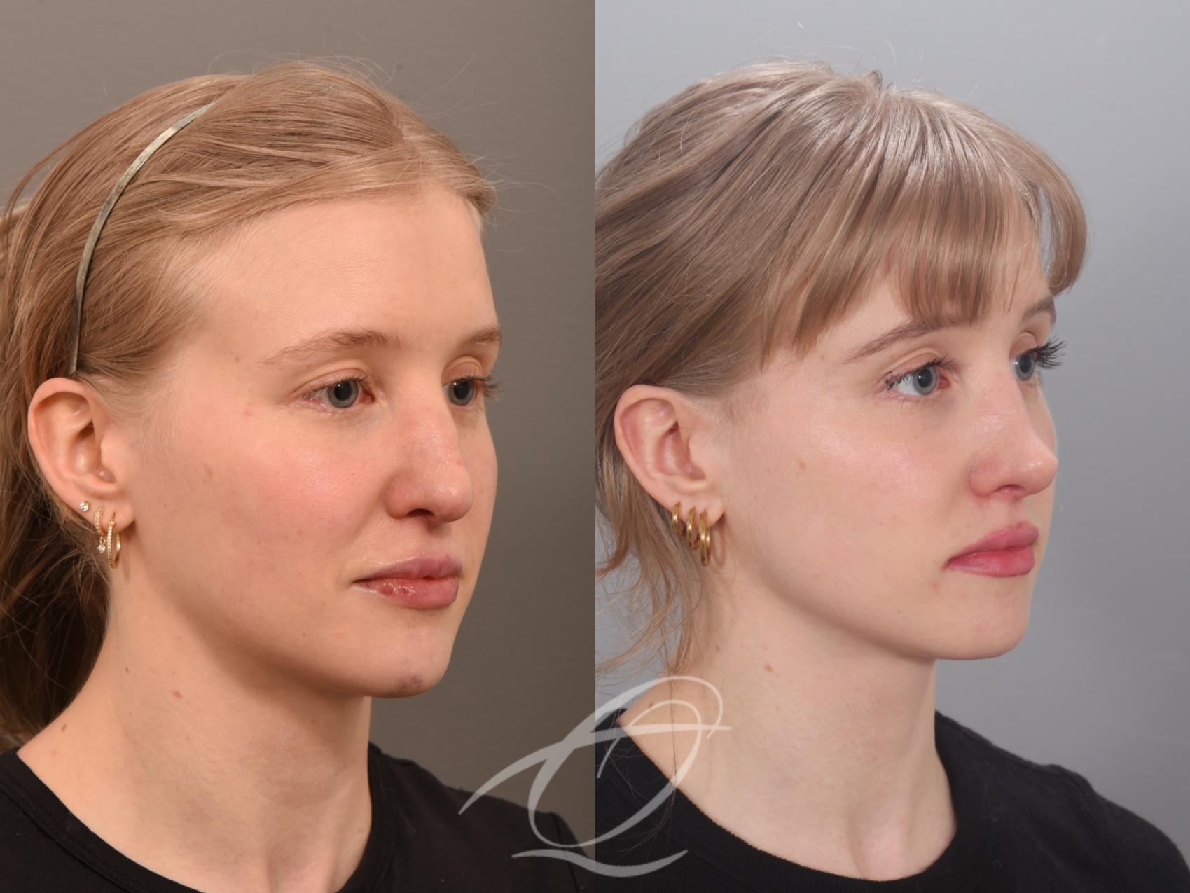 Revision Rhinoplasty Case 1002012 Before & After Right Oblique | Serving Rochester, Syracuse & Buffalo, NY | Quatela Center for Plastic Surgery