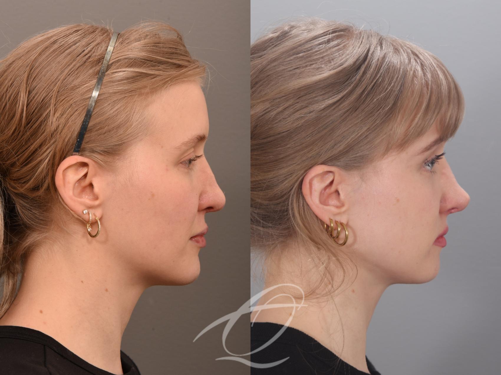 Revision Rhinoplasty Case 1002012 Before & After Right Side | Serving Rochester, Syracuse & Buffalo, NY | Quatela Center for Plastic Surgery