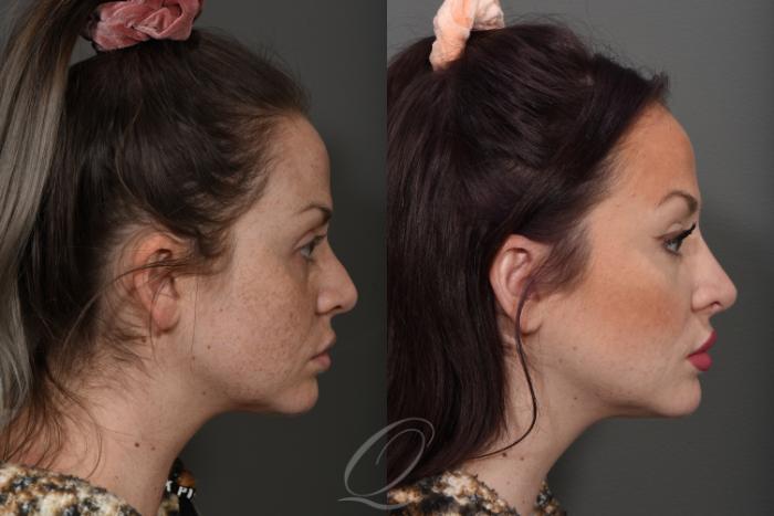 Revision Rhinoplasty Case 370 Before & After View #3 | Serving Rochester, Syracuse & Buffalo, NY | Quatela Center for Plastic Surgery