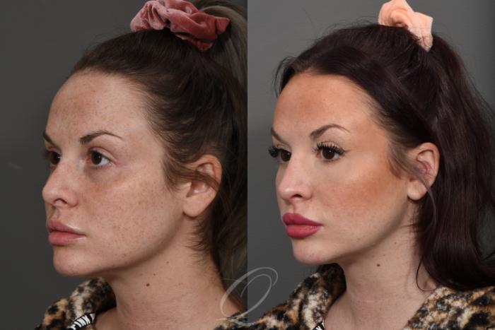 Revision Rhinoplasty Case 370 Before & After View #4 | Serving Rochester, Syracuse & Buffalo, NY | Quatela Center for Plastic Surgery