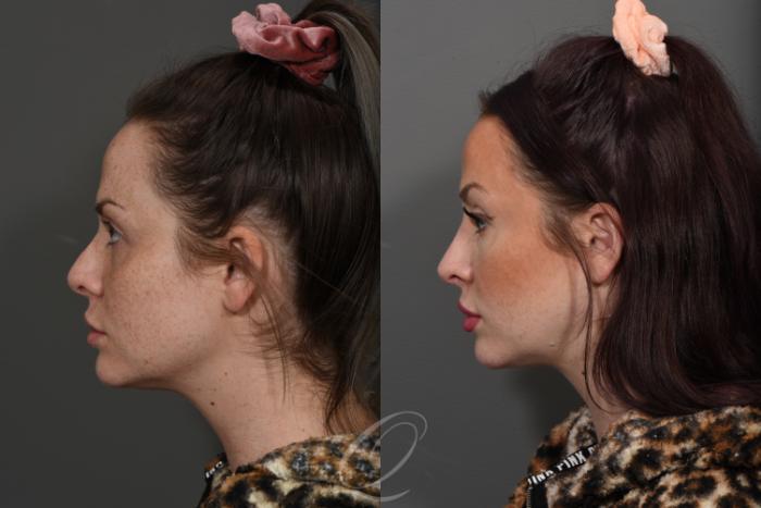 Revision Rhinoplasty Case 370 Before & After View #5 | Serving Rochester, Syracuse & Buffalo, NY | Quatela Center for Plastic Surgery
