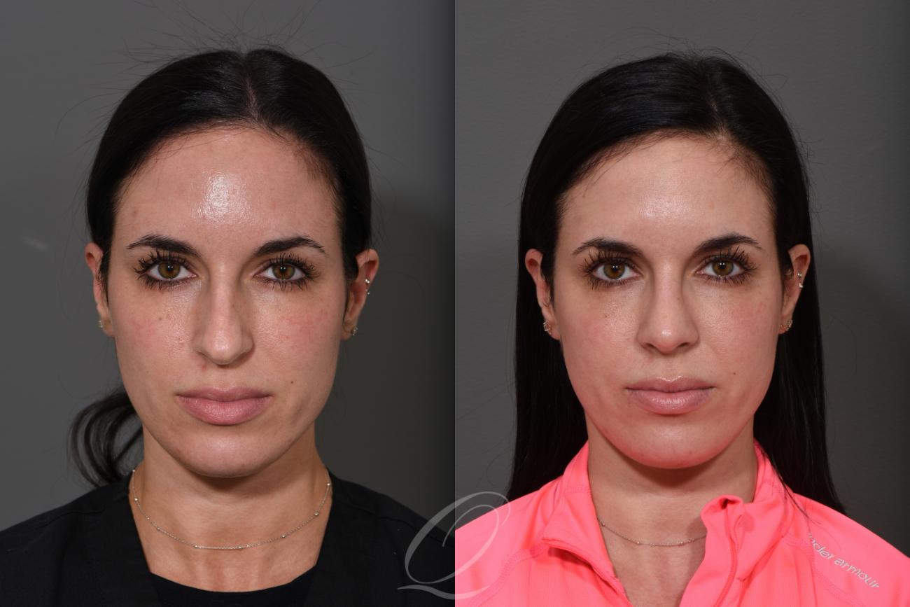 Rhinoplasty Case 362 Before & After View #1 | Serving Rochester, Syracuse & Buffalo, NY | Quatela Center for Plastic Surgery