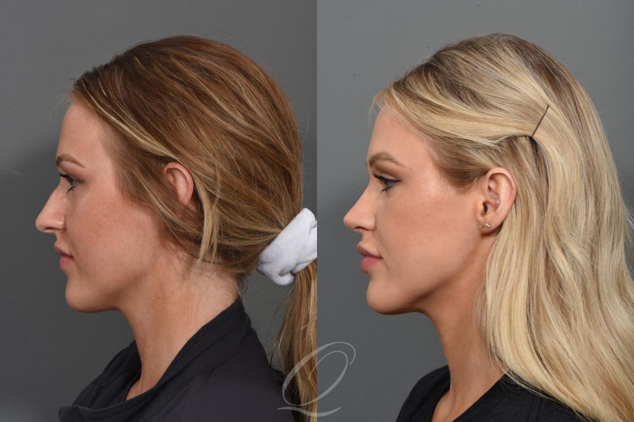 Rhinoplasty Case 1001373 Before & After Left Side | Serving Rochester, Syracuse & Buffalo, NY | Quatela Center for Plastic Surgery