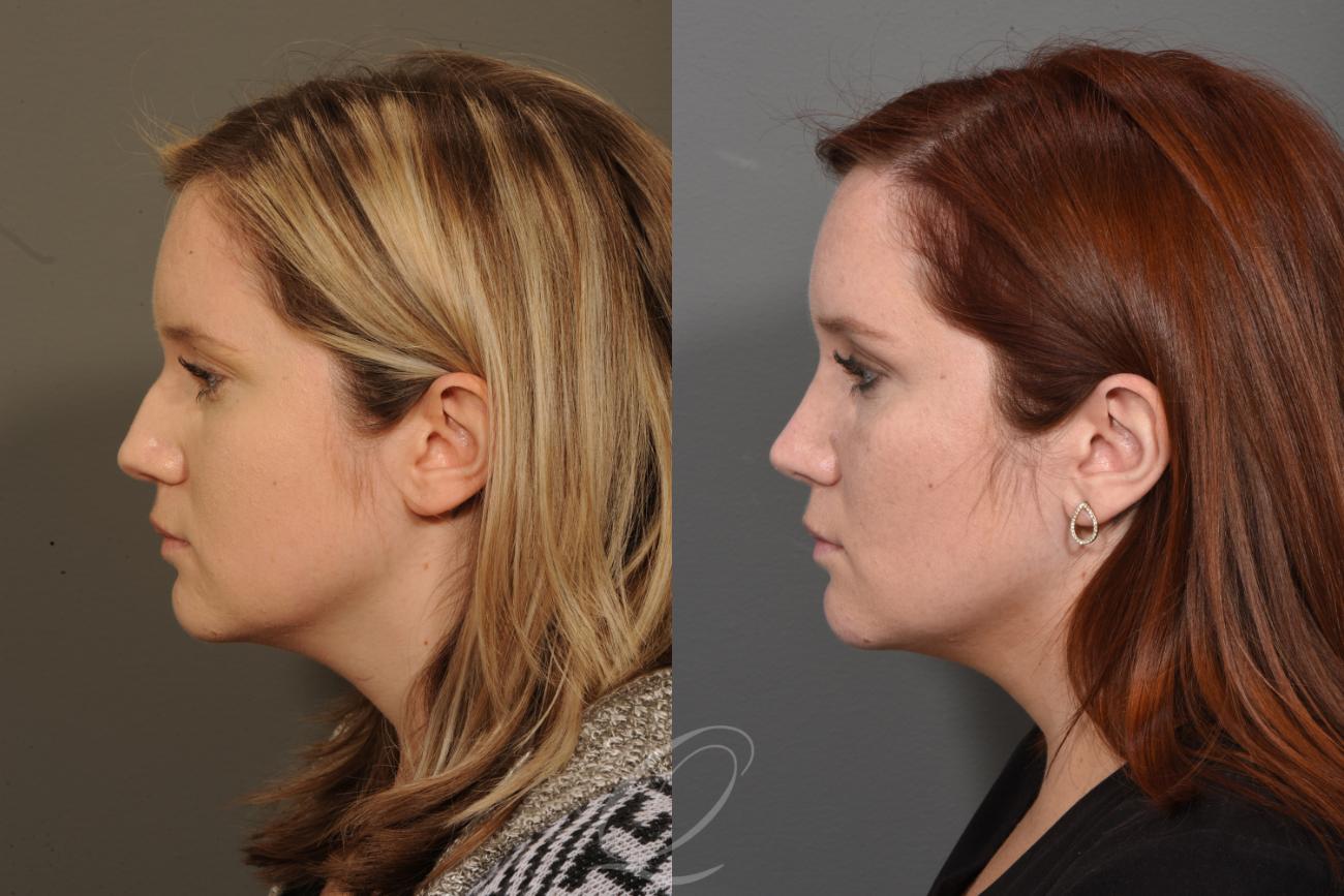 Rhinoplasty Case 1375 Before & After Left Side | Serving Rochester, Syracuse & Buffalo, NY | Quatela Center for Plastic Surgery