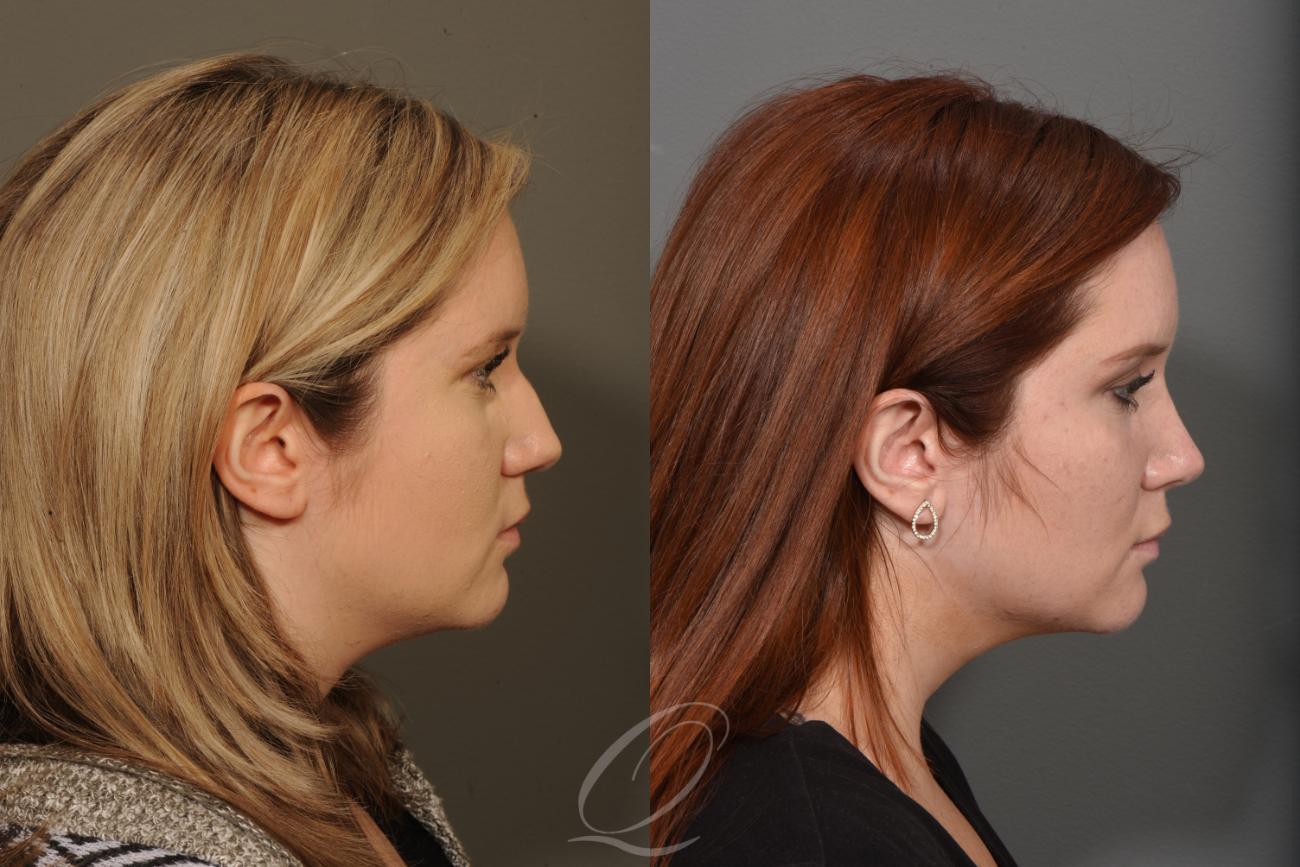 Rhinoplasty Case 1375 Before & After Right Side | Serving Rochester, Syracuse & Buffalo, NY | Quatela Center for Plastic Surgery