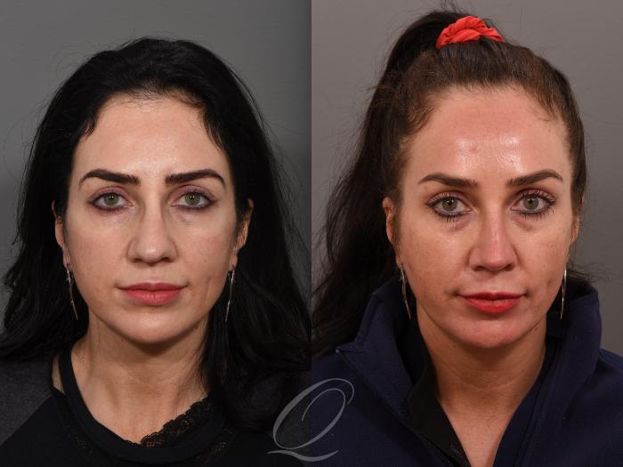 Rhinoplasty Case 1001506 Before & After Front | Serving Rochester, Syracuse & Buffalo, NY | Quatela Center for Plastic Surgery