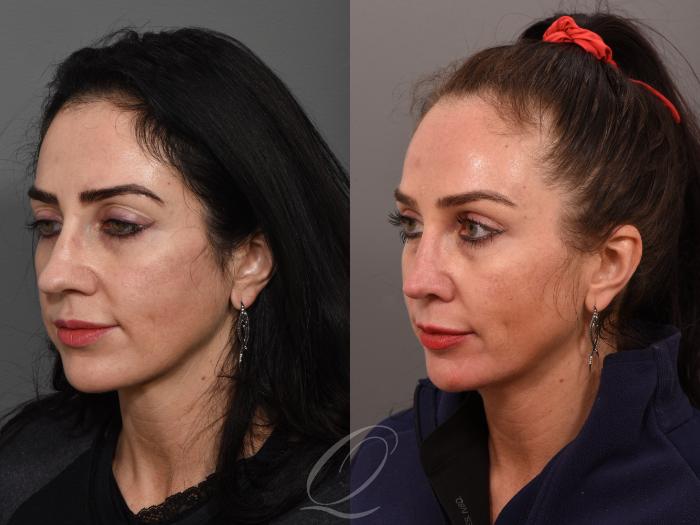 Rhinoplasty Case 1001506 Before & After Left Oblique | Serving Rochester, Syracuse & Buffalo, NY | Quatela Center for Plastic Surgery