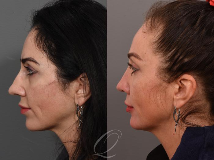 Rhinoplasty Case 1001506 Before & After Left Side | Serving Rochester, Syracuse & Buffalo, NY | Quatela Center for Plastic Surgery