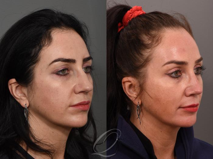 Rhinoplasty Case 1001506 Before & After Right Oblique | Serving Rochester, Syracuse & Buffalo, NY | Quatela Center for Plastic Surgery