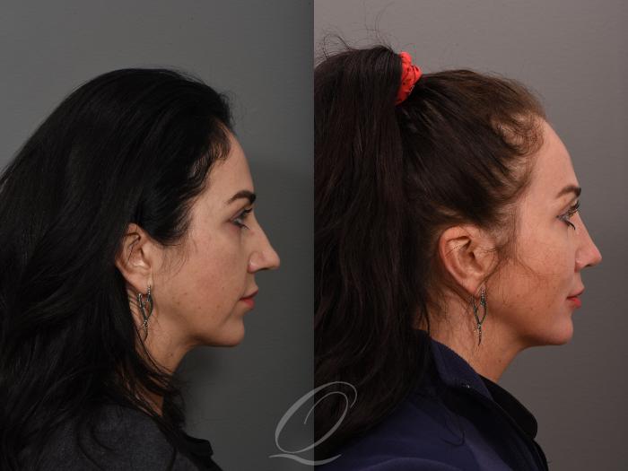 Rhinoplasty Case 1001506 Before & After Right Side | Serving Rochester, Syracuse & Buffalo, NY | Quatela Center for Plastic Surgery