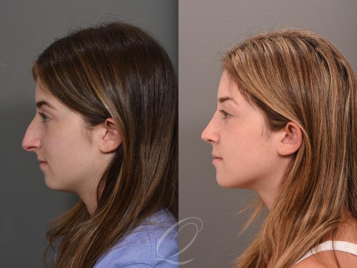 Rhinoplasty Case 1001524 Before & After Left Side | Serving Rochester, Syracuse & Buffalo, NY | Quatela Center for Plastic Surgery