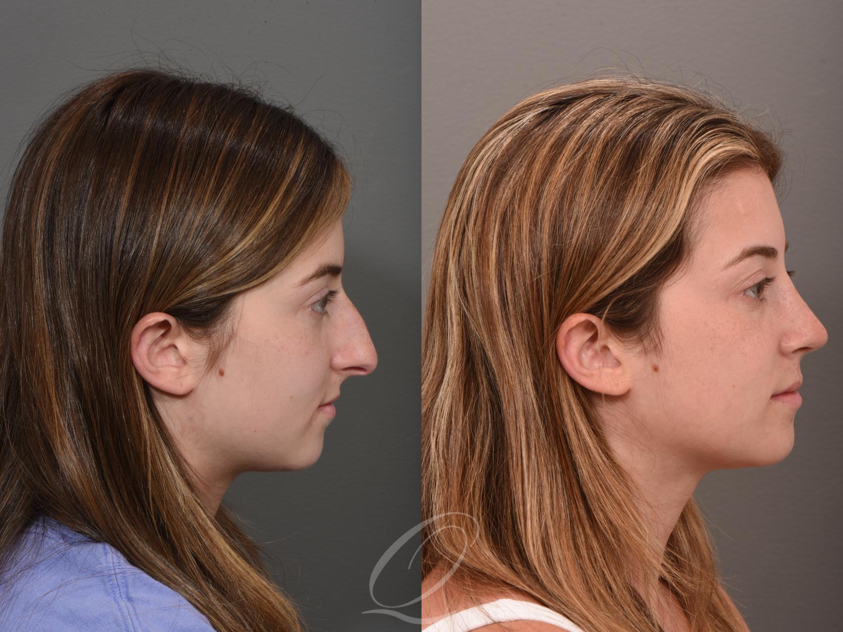 Rhinoplasty Case 1001524 Before & After Right Side | Serving Rochester, Syracuse & Buffalo, NY | Quatela Center for Plastic Surgery