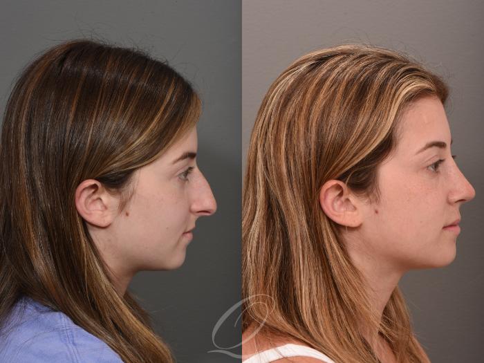 Rhinoplasty Case 1001524 Before & After Right Side | Serving Rochester, Syracuse & Buffalo, NY | Quatela Center for Plastic Surgery