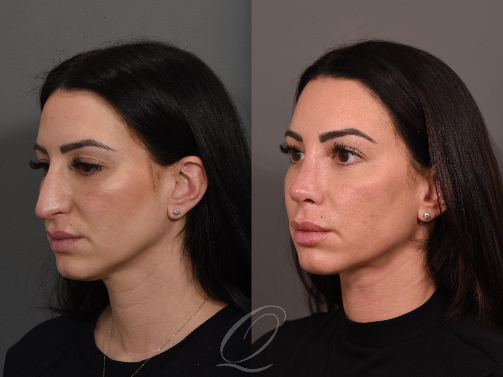 Rhinoplasty Case 1001525 Before & After Left Oblique | Serving Rochester, Syracuse & Buffalo, NY | Quatela Center for Plastic Surgery