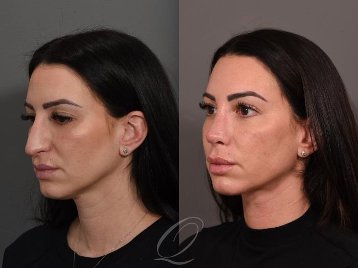 Deep Neck Contouring Case 1001525 Before & After Left Oblique | Serving Rochester, Syracuse & Buffalo, NY | Quatela Center for Plastic Surgery