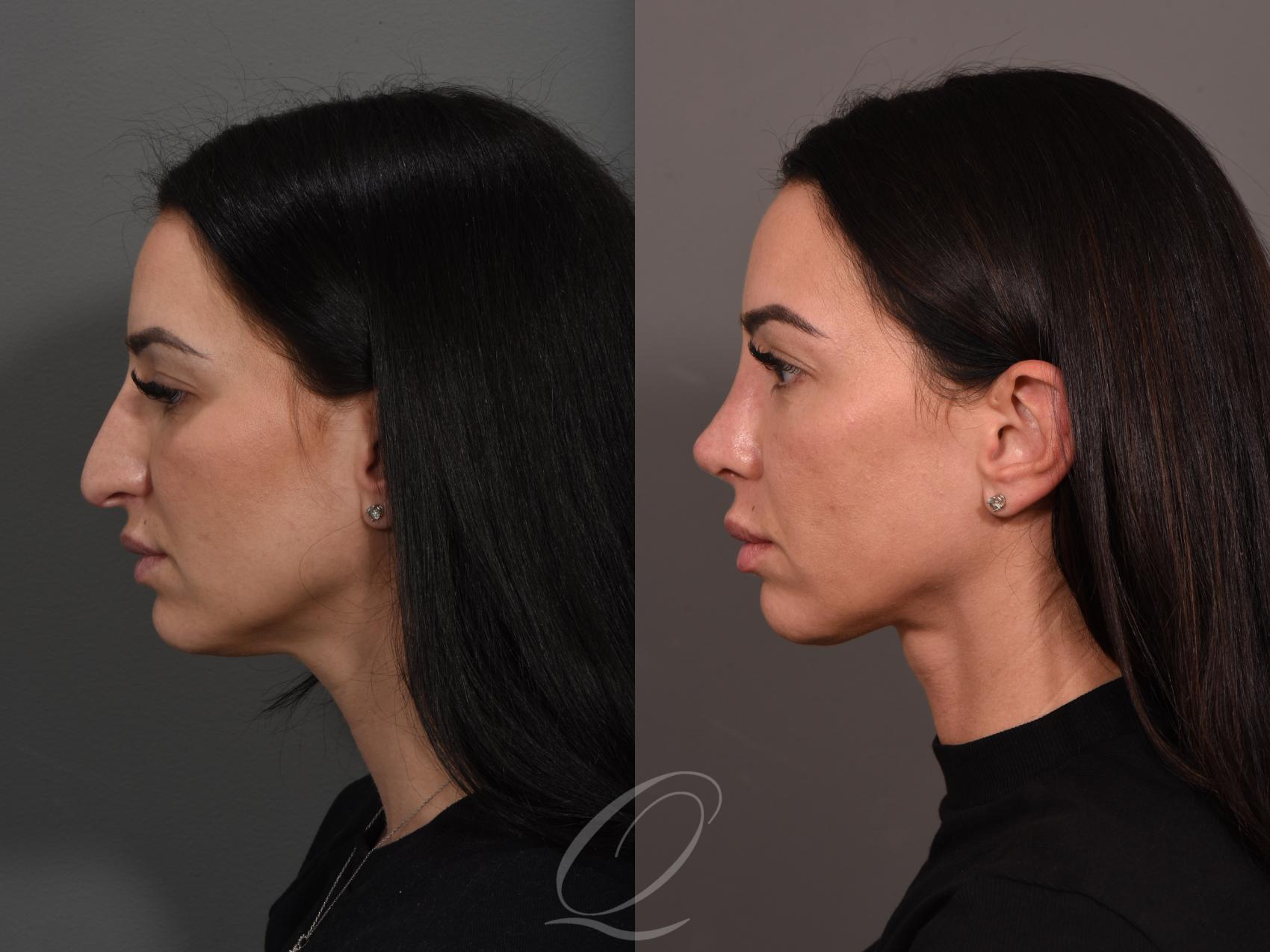Deep Neck Contouring Case 1001525 Before & After Left Side | Serving Rochester, Syracuse & Buffalo, NY | Quatela Center for Plastic Surgery