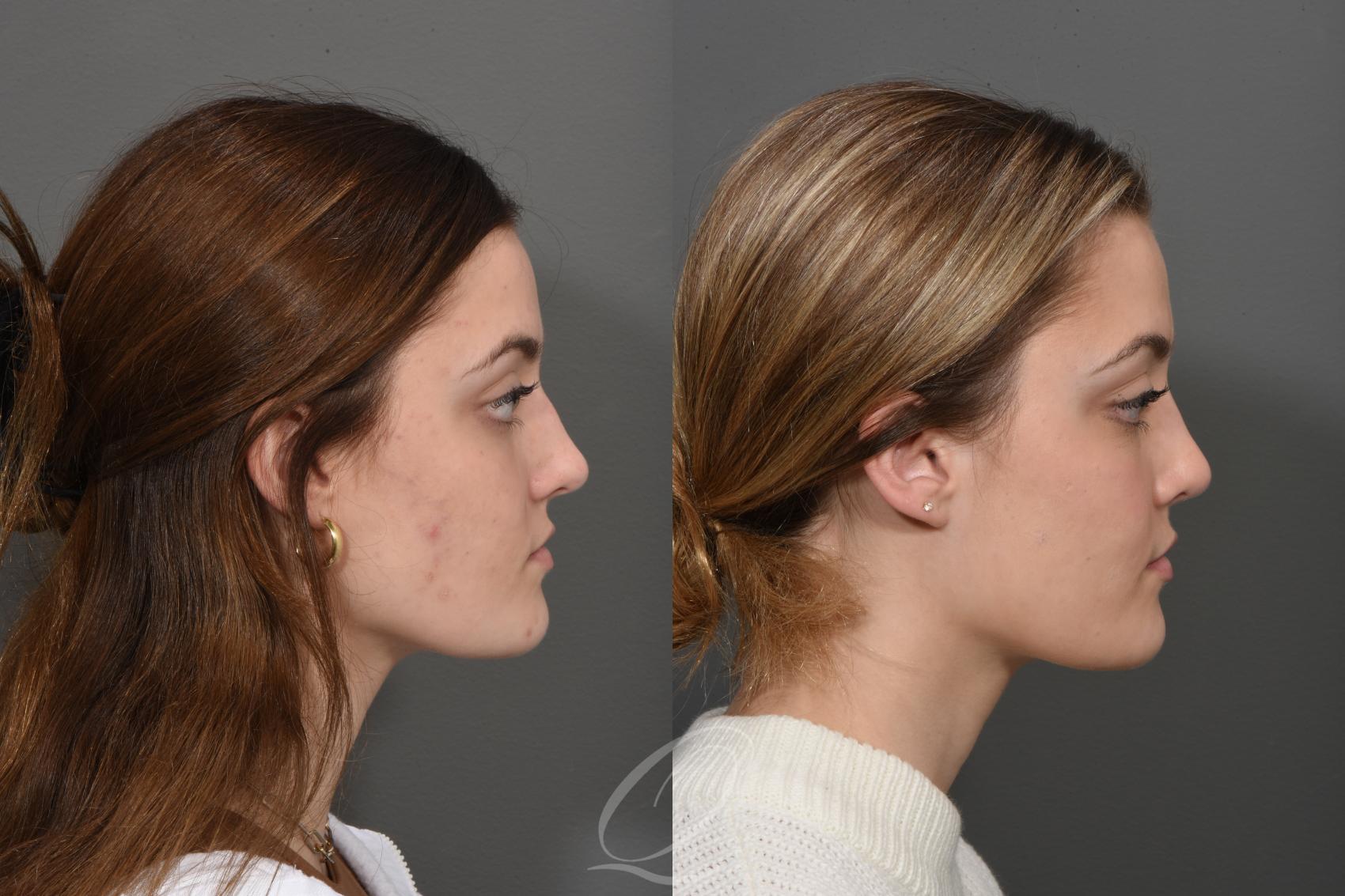 Rhinoplasty Case 1001550 Before & After Right Side | Serving Rochester, Syracuse & Buffalo, NY | Quatela Center for Plastic Surgery