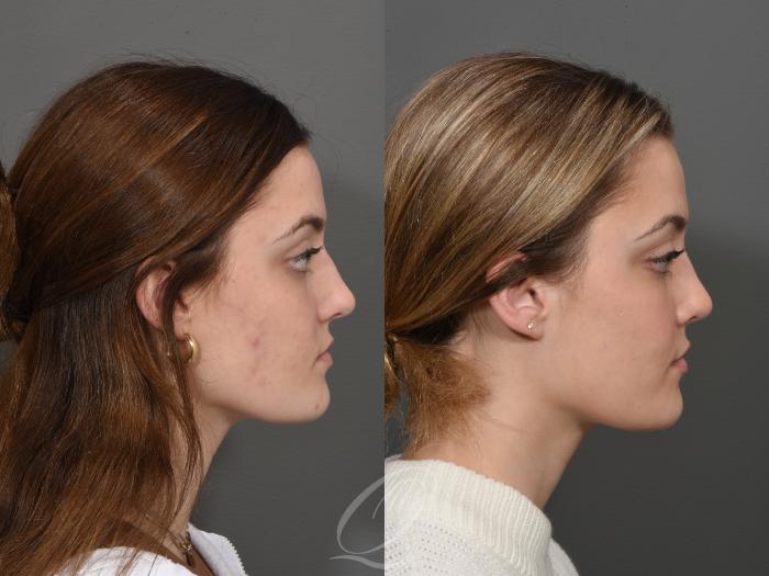 Rhinoplasty Case 1001550 Before & After Right Side | Serving Rochester, Syracuse & Buffalo, NY | Quatela Center for Plastic Surgery