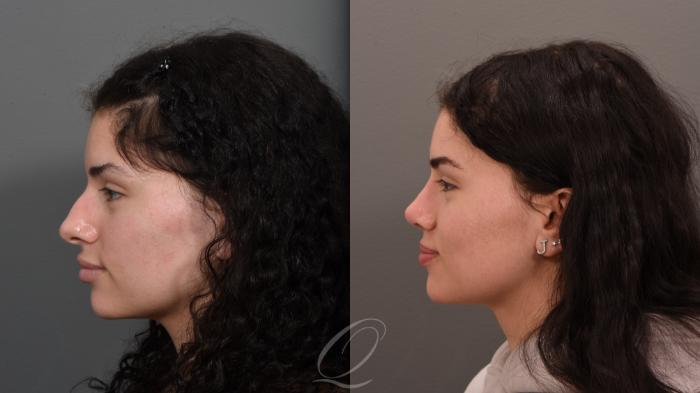 Rhinoplasty Case 1001553 Before & After Left Side | Serving Rochester, Syracuse & Buffalo, NY | Quatela Center for Plastic Surgery