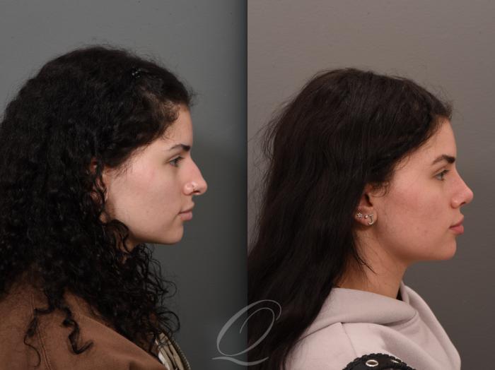 Rhinoplasty Case 1001553 Before & After Right Side | Serving Rochester, Syracuse & Buffalo, NY | Quatela Center for Plastic Surgery