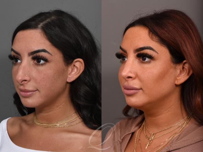Rhinoplasty Case 1001557 Before & After Left Oblique | Serving Rochester, Syracuse & Buffalo, NY | Quatela Center for Plastic Surgery