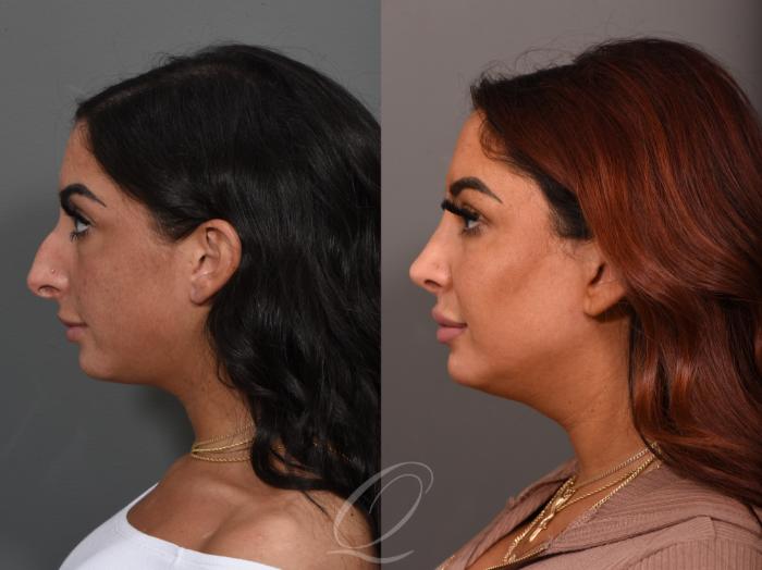 Rhinoplasty Case 1001557 Before & After Left Side | Serving Rochester, Syracuse & Buffalo, NY | Quatela Center for Plastic Surgery