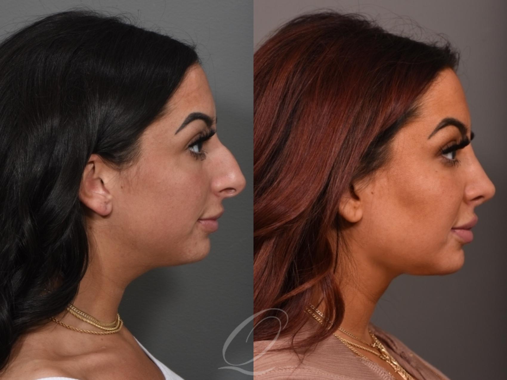 Rhinoplasty Case 1001557 Before & After Right Side | Serving Rochester, Syracuse & Buffalo, NY | Quatela Center for Plastic Surgery