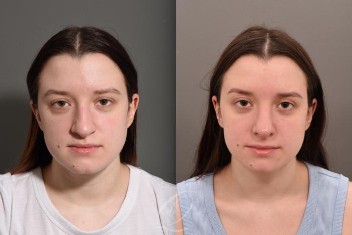 Rhinoplasty Case 1001562 Before & After Front | Serving Rochester, Syracuse & Buffalo, NY | Quatela Center for Plastic Surgery