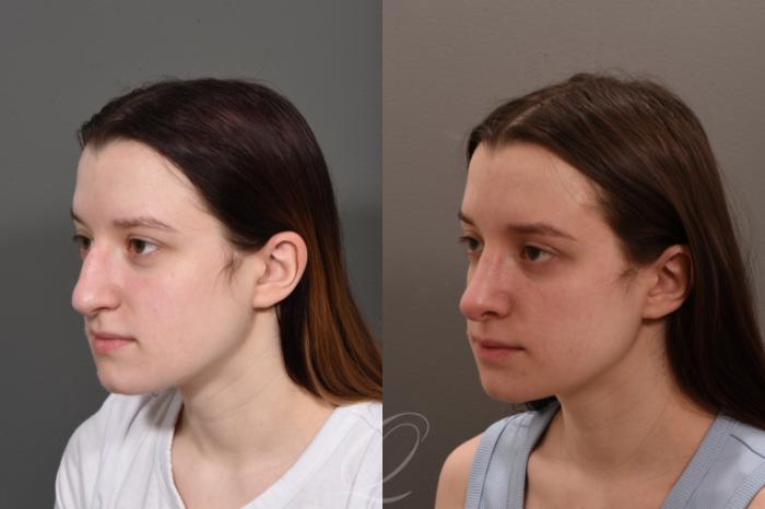Rhinoplasty Case 1001562 Before & After Left Oblique | Serving Rochester, Syracuse & Buffalo, NY | Quatela Center for Plastic Surgery