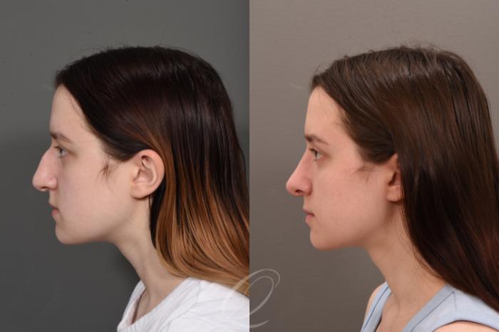 Rhinoplasty Case 1001562 Before & After Left Side | Serving Rochester, Syracuse & Buffalo, NY | Quatela Center for Plastic Surgery